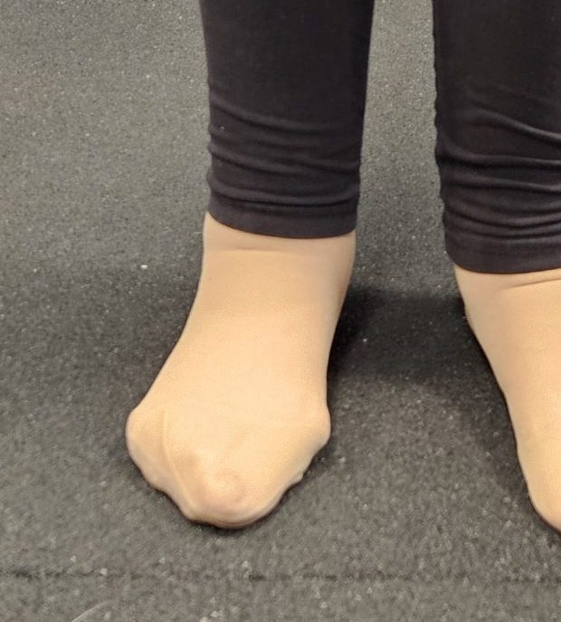 krivi palec hallux valgus bunkica vijačenje metatarzalna kost biomehanika stopala