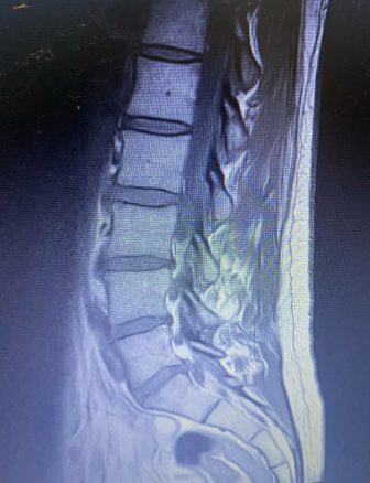 MR ledvene hrbtenice protruzija L5 S1 orientacija križnice ledvena lordoza analiza