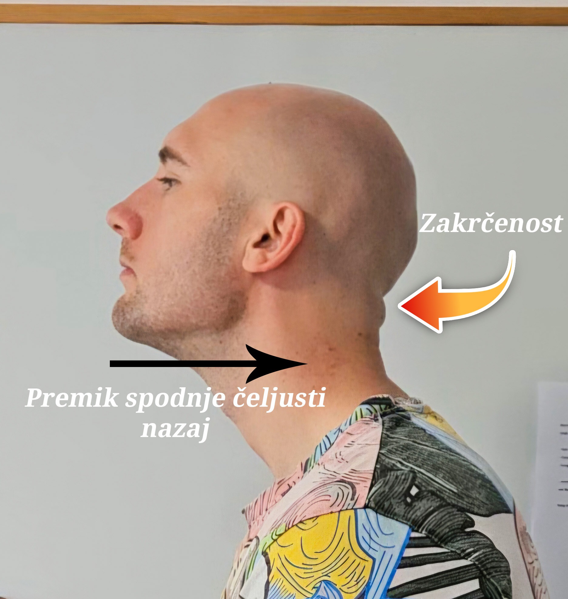 podjezičnica premik čeljust glava naprej sapnik biomehanika