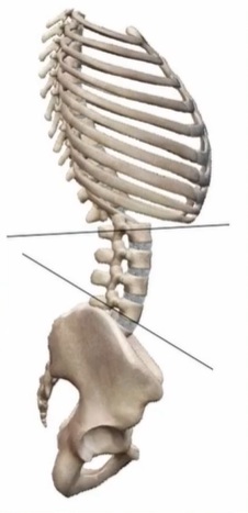 poudarjena ledvena krivina anteriorni nagib medenice lordoza pritisk ledveni del