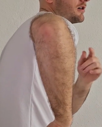 kompenzacija notranje rotacije rame nagib naprej vzporedba z anteriornim nagibom medenice