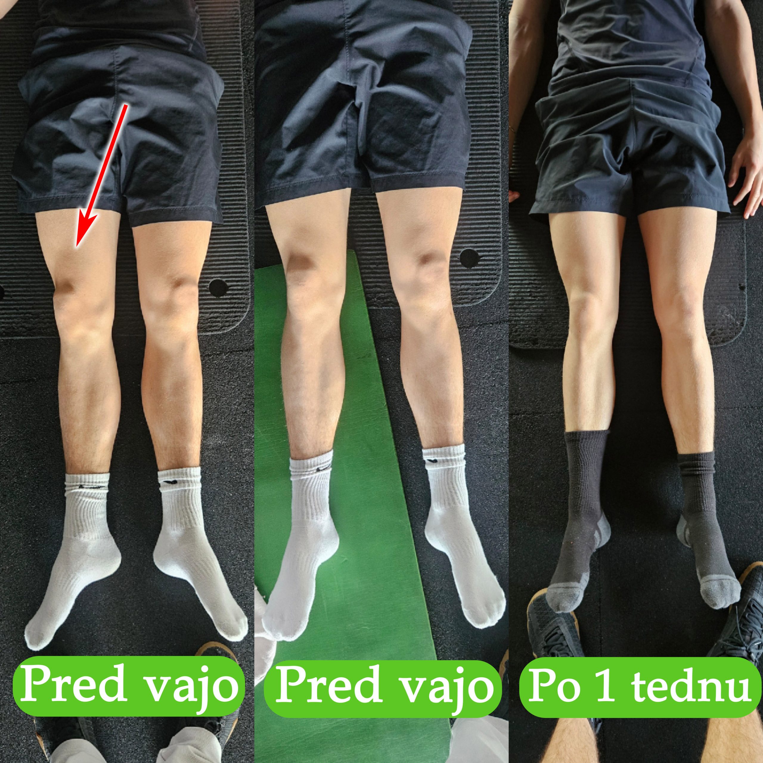 profesionalni smučar hernija ledvenega dela sprememba obrata noge