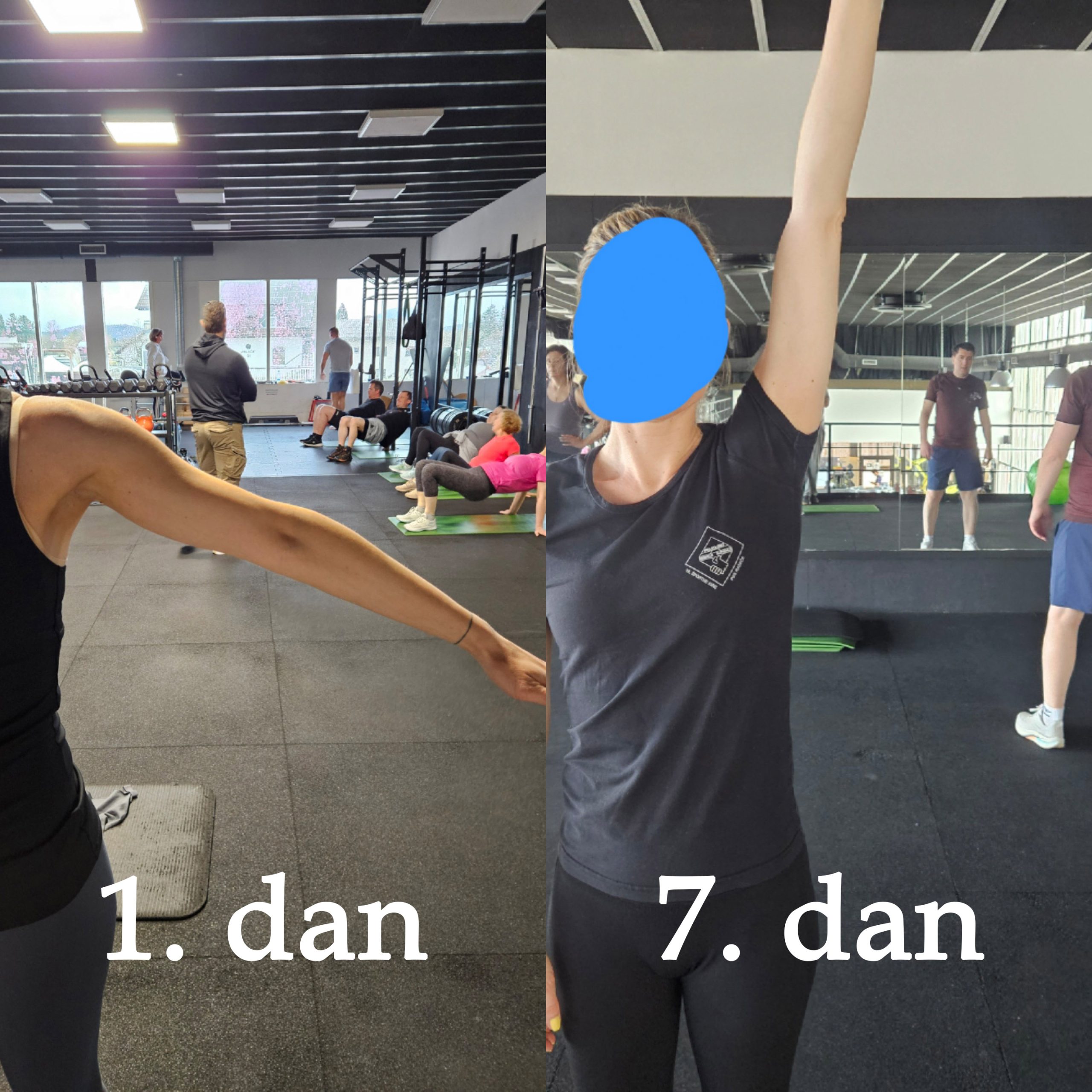 kalcinacija ramena izboljšan dvig roke po 7 dneh vaj