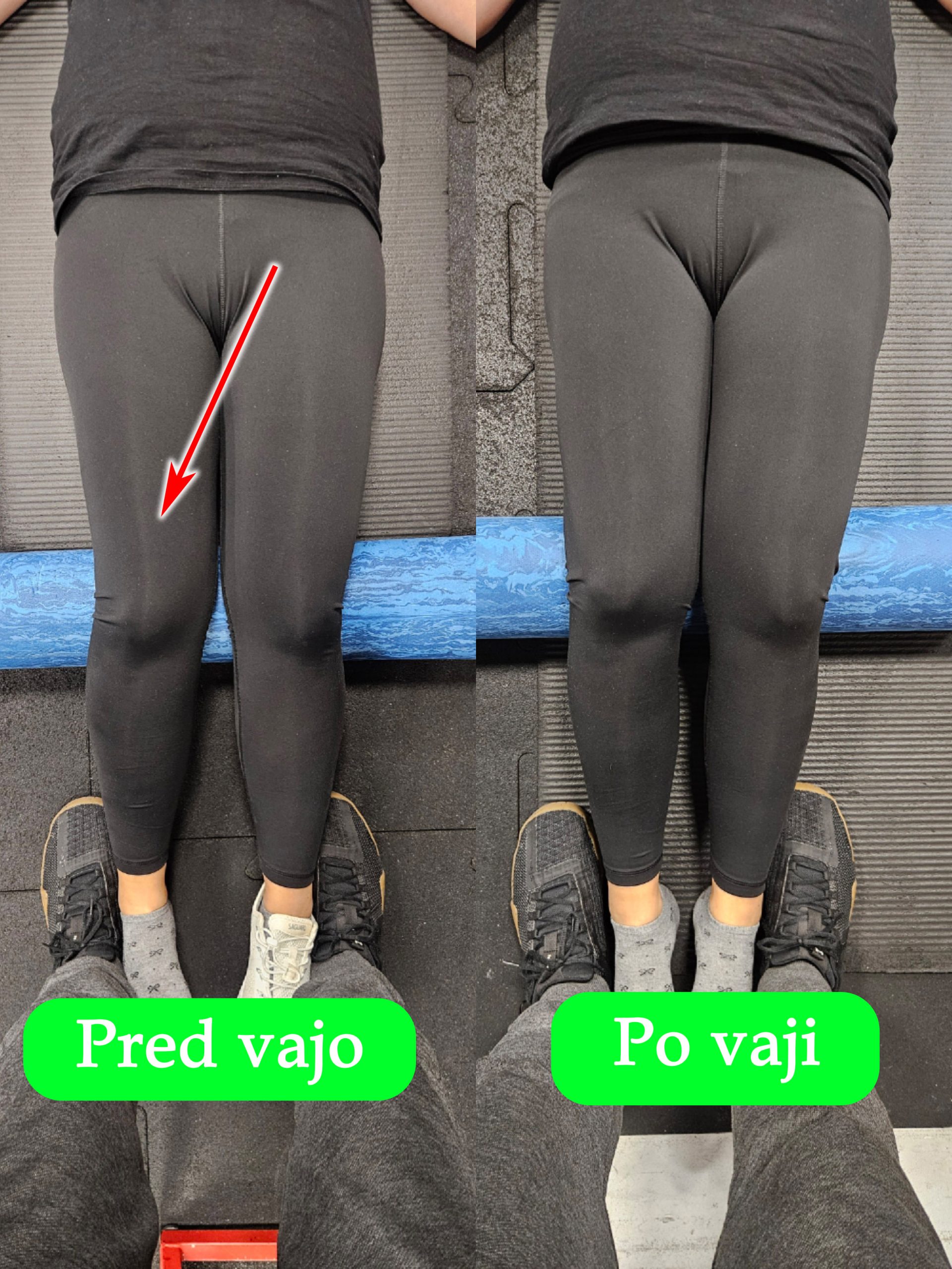 bolečina v križu valgus kolena pred vajo in izboljšano stanje po vaji