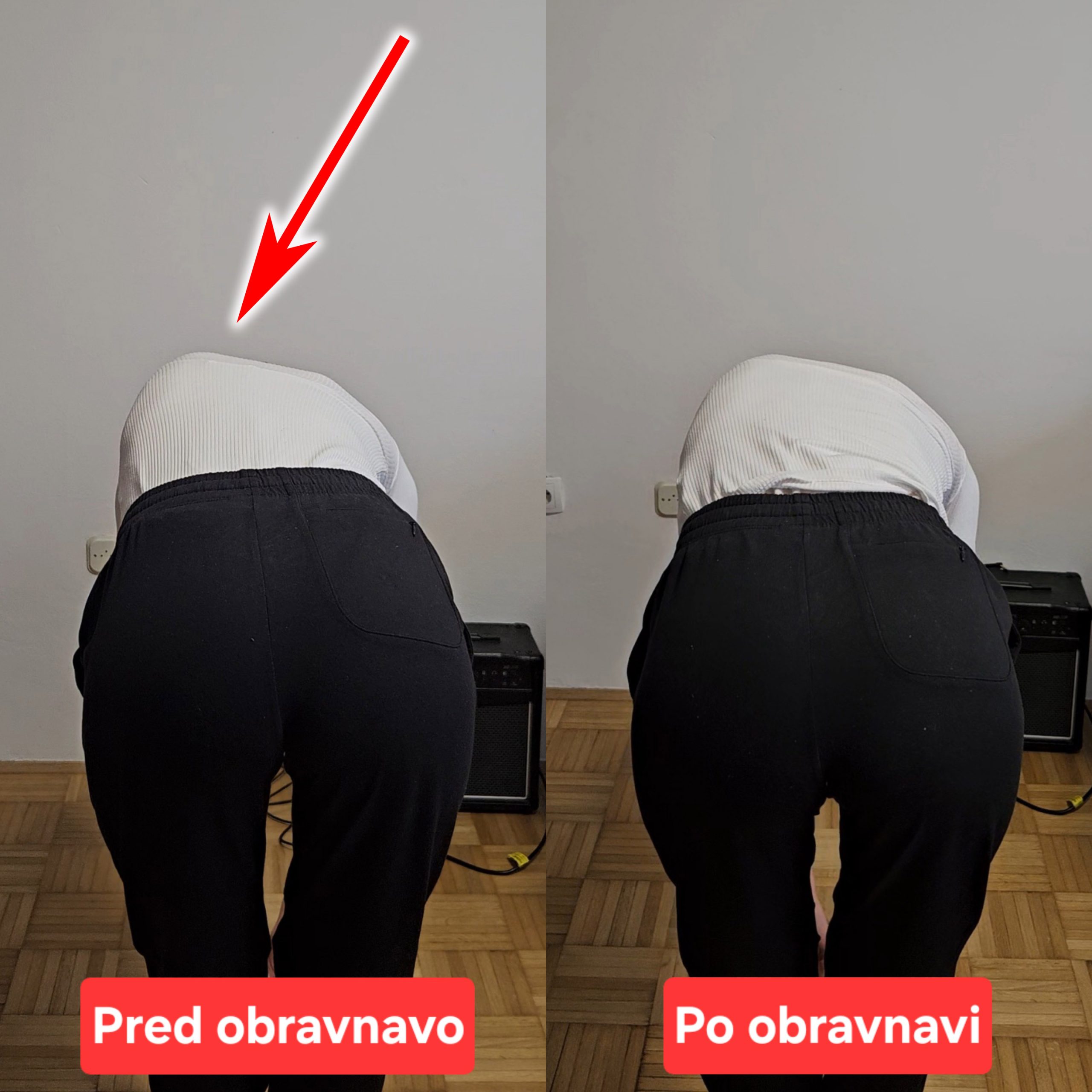sprememba oblike hrbtenice skolioza pred in po obravnavi