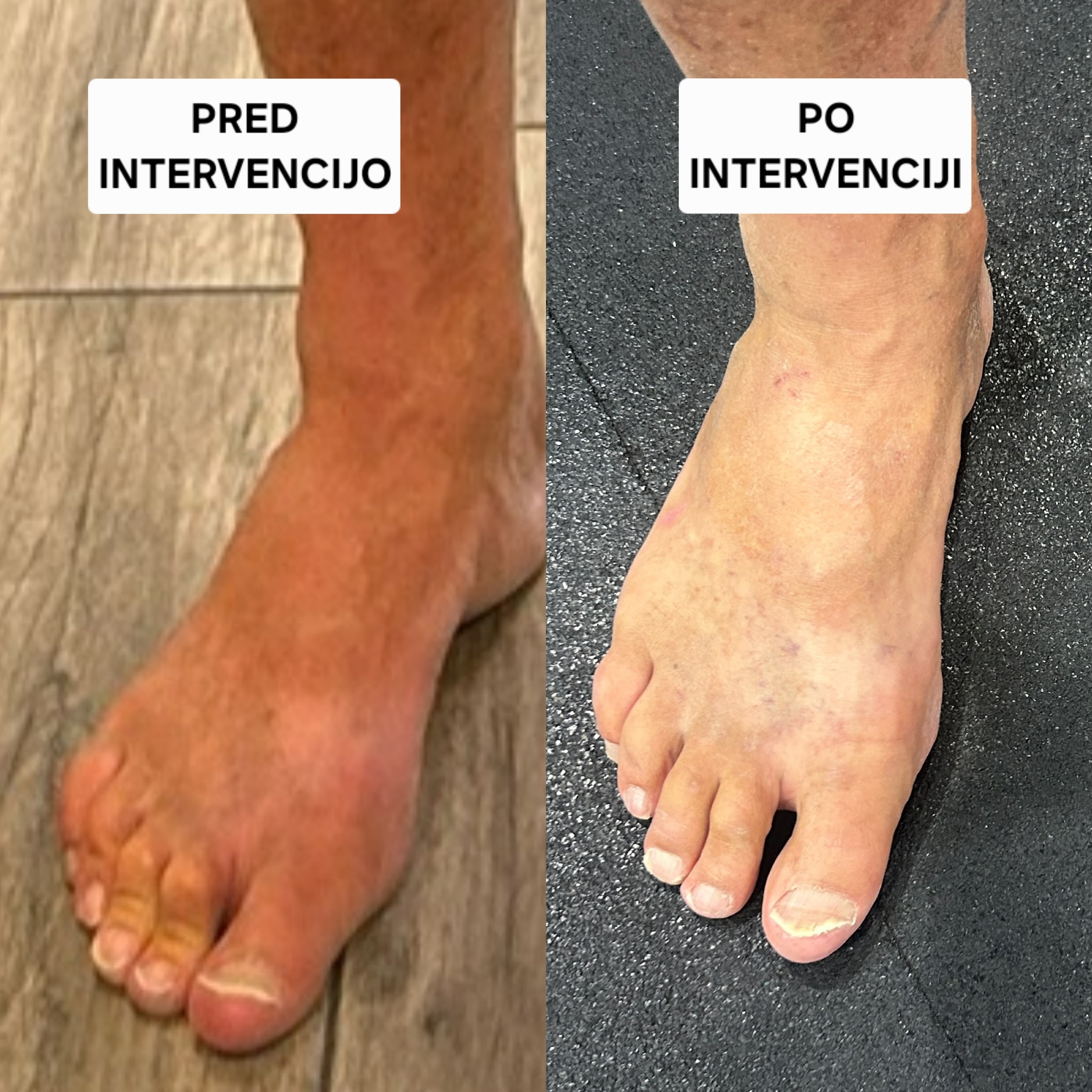 Nikov varovanec pred in po izboljšani kinetični verigi manj grabljenja tal pri stopalu
